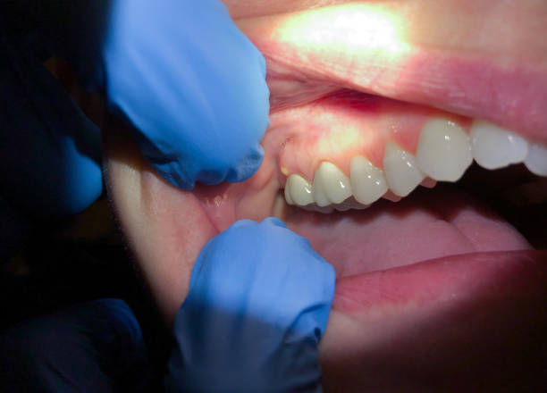 Best Chipped Tooth Repair Near Me  in Hallstead, PA